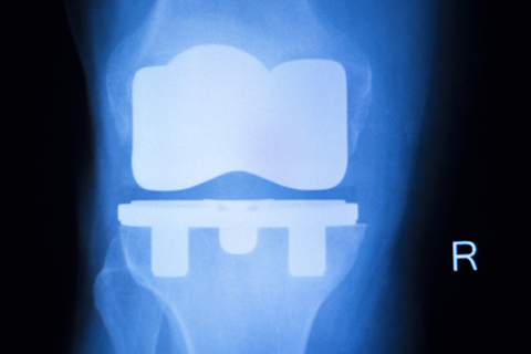 faulty knee implants