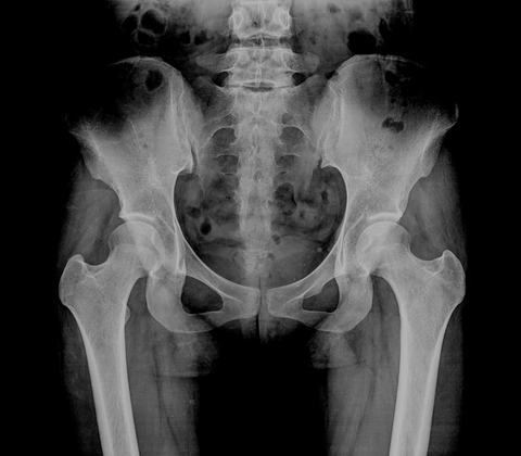hip resurfacing