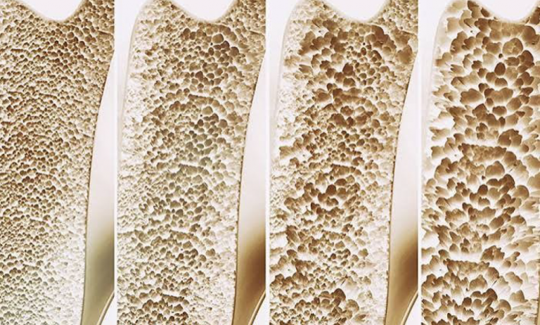 Women’s Bone Health: Preventing Osteoporosis and Fragility Fractures